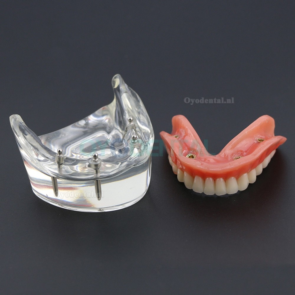 Demo-onderzoek tandheelkundige onderste tanden Model 6002 02 Overdenture Inferior 4 implantaten